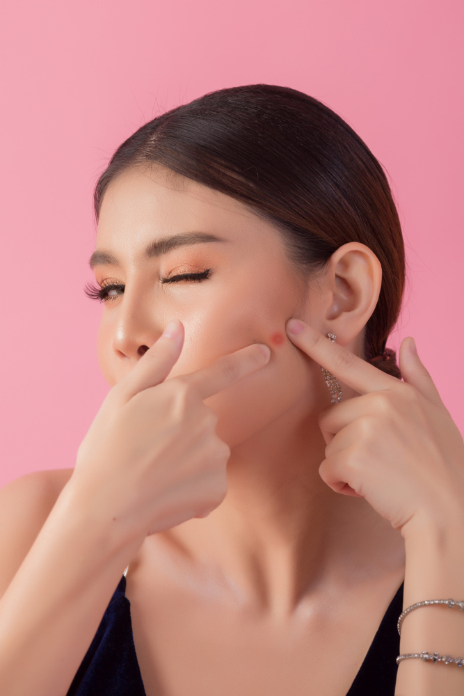 Cara menggunakan acne patch agar tidak meninggalkan bekas jerawat