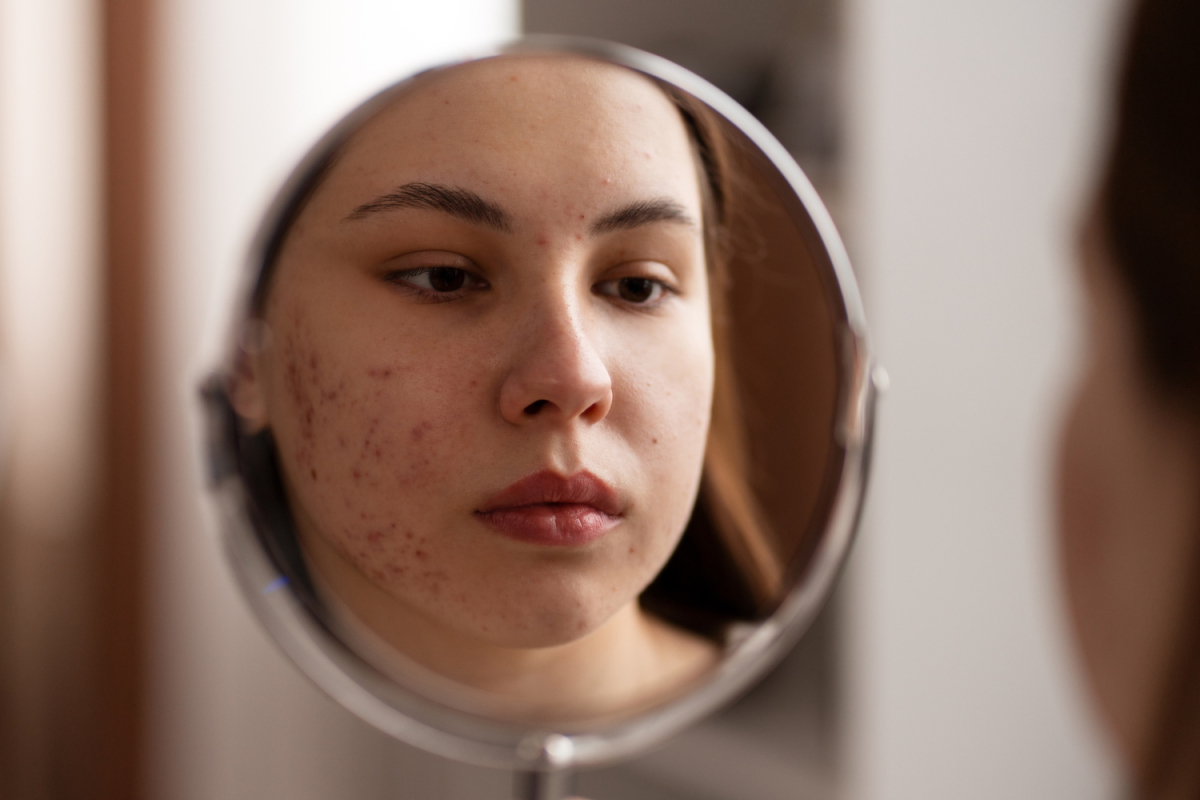 Kenapa jerawat susah hilang padahal sudah pakai skincare