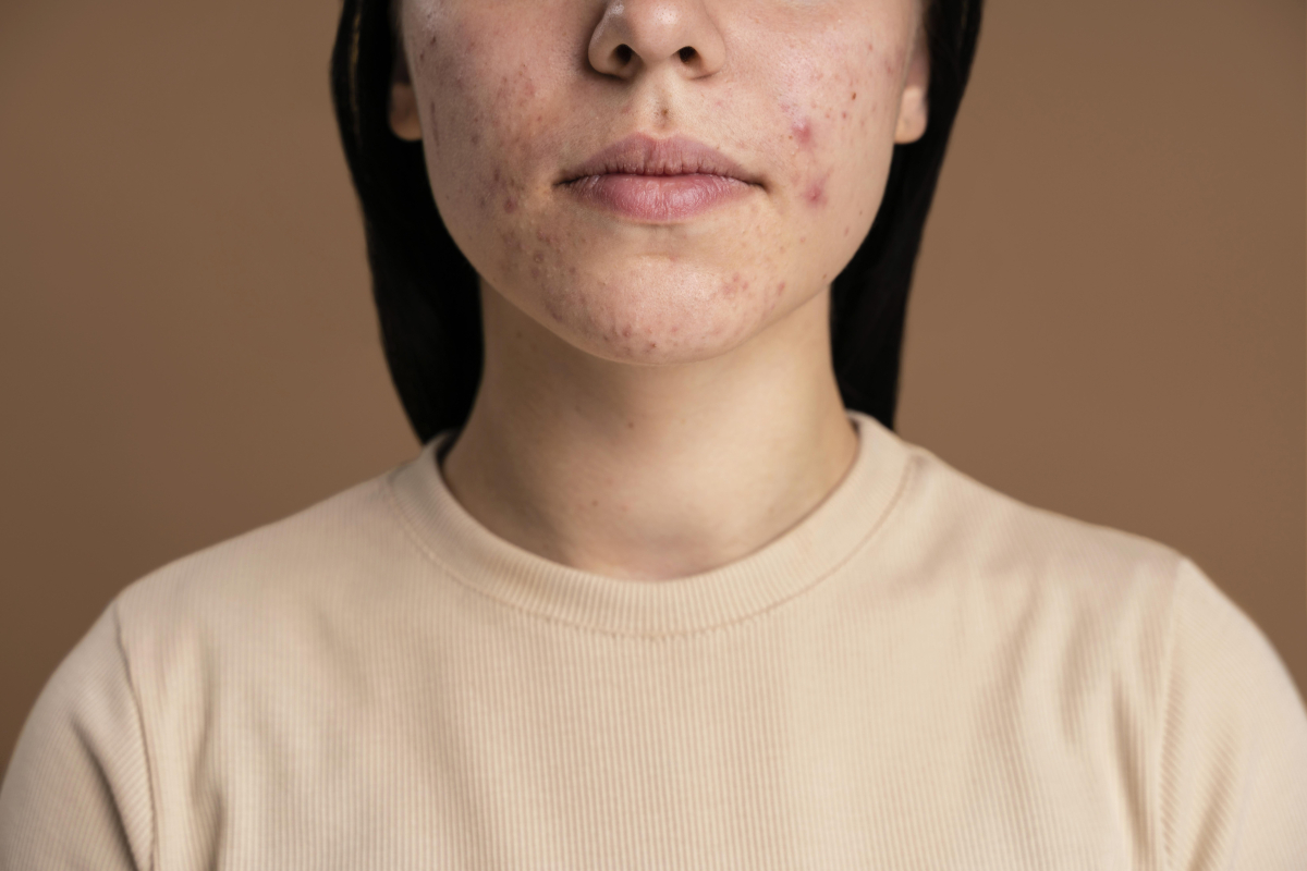Penyebab adult acne