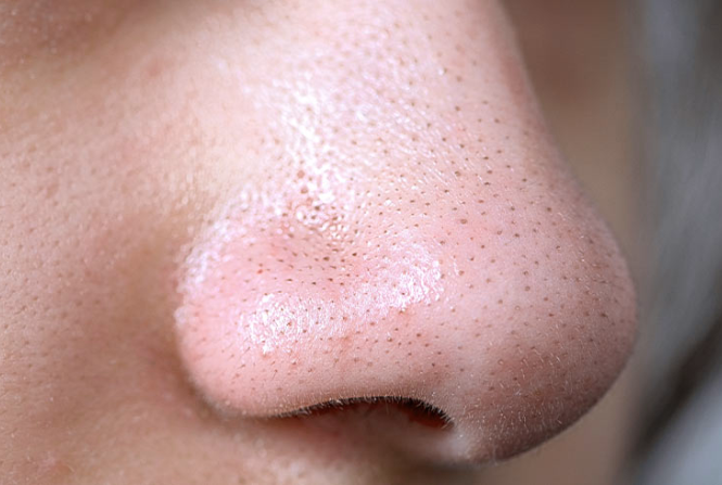 Cara Menghilangkan Komedo Hitam, Kenali Metode yang Tepat