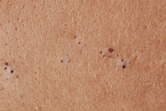 Cara Menghilangkan Komedo Hitam, Kenali Metode yang Tepat