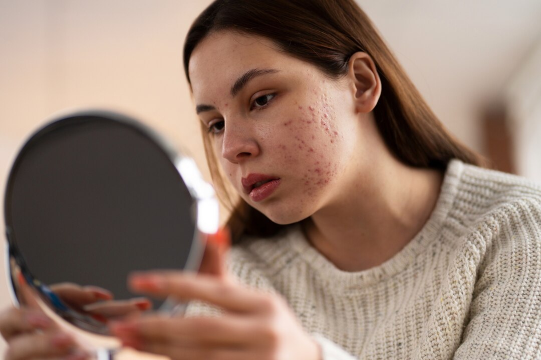 Ilustrasi rosacea