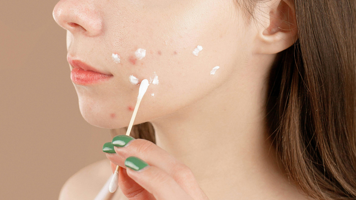 Jerawat Tidak Kunjung Sembuh? Mungkin Karena Hal-hal Ini&hellip;