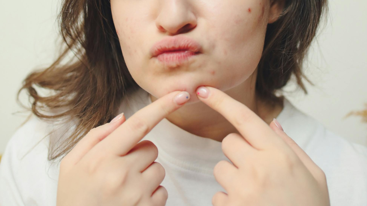 Jerawat Tidak Kunjung Sembuh? Mungkin Karena Hal-hal Ini&hellip;