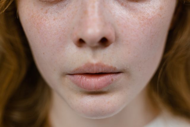 Cara mengobati luka di sudut bibir secara alami