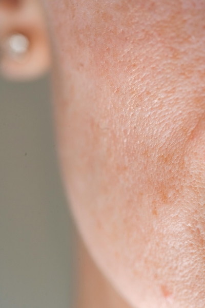 Keratosis pilaris