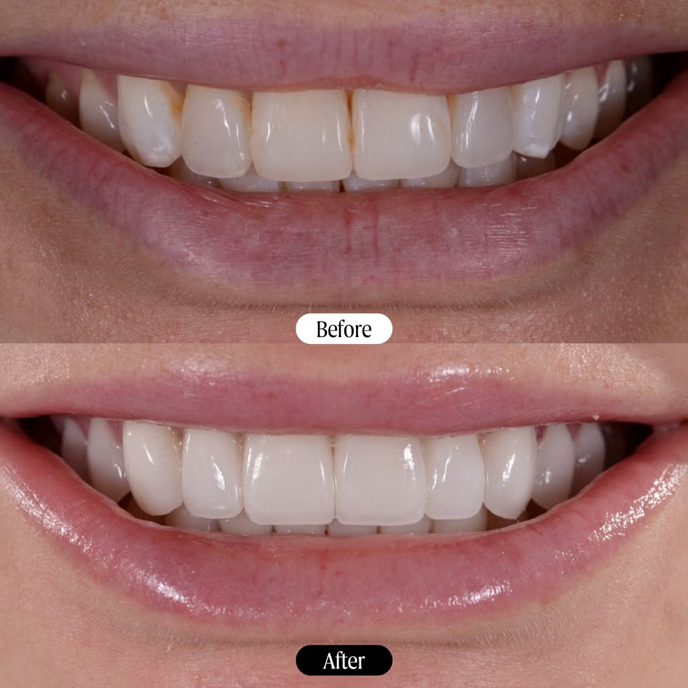 Panduan lengkap tentang veneer gigi