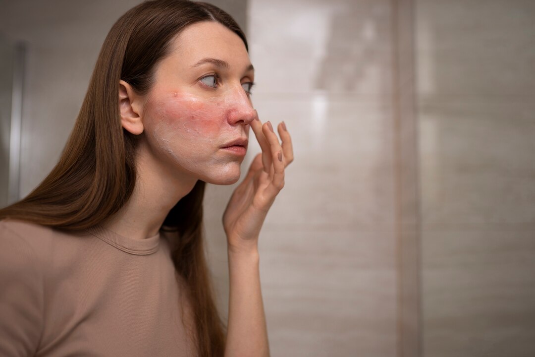 Ilustrasi rosacea