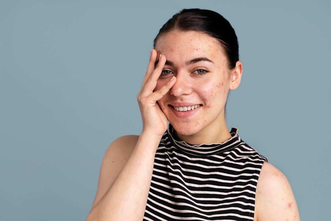 Ilustrasi rosacea