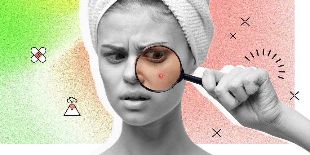 Ini Dia Penyebab Adult Acne dan 7 Cara Mengatasinya!
