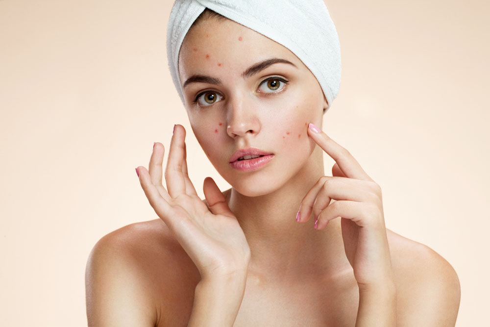 Beauty Q&A: Perawatan apakah yang cocok untuk jerawat hormonal?