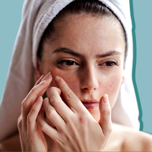 Apa Itu Adult Acne Dan Apa Saja Penyebabnya?