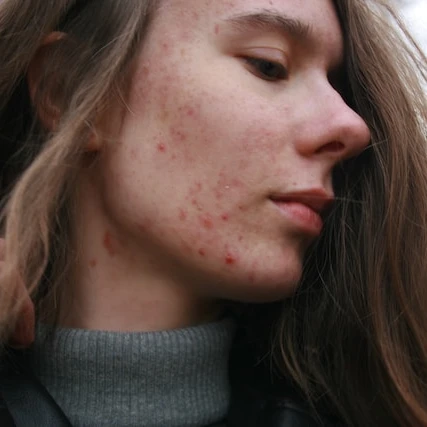 Apa Itu Acne Prone Skin & Cara Perawatannya yang Tepat