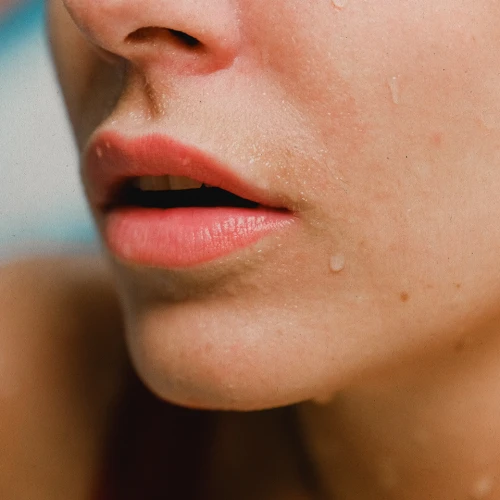 Ini Penyebab dan Solusi Mengatasi Jerawat di Dagu Menurut Dermatologis