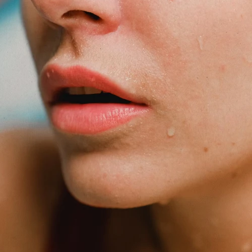 Menurut Dermatologis, Berikut Adalah Penyebab dan Cara Efektif Mengatasi Jerawat di Dagu