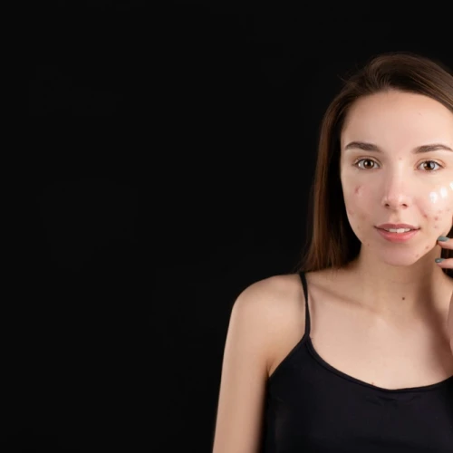 Simak Segala Hal Tentang Acne Prone Skin yang Perlu Kamu Ketahui!