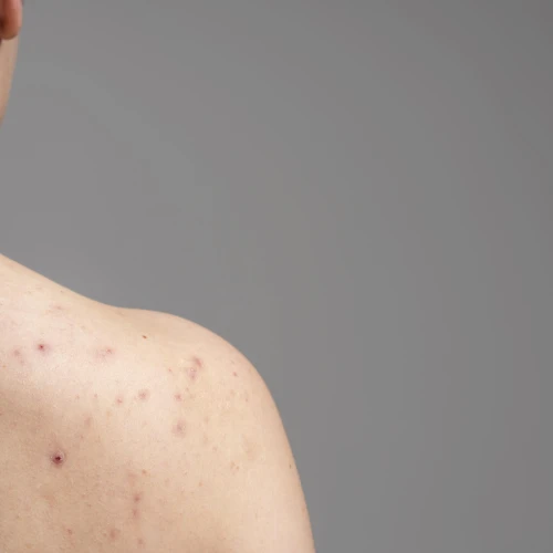 Cara Mencegah Body Acne