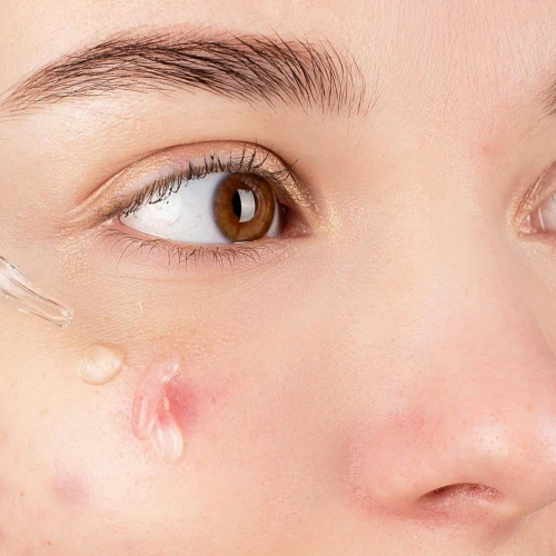 5 Kandungan Skincare Terbaik untuk Kulit Kemerahan atau Berjerawat