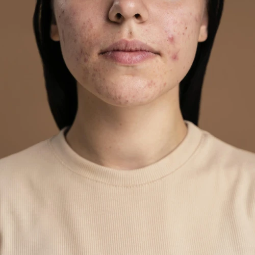 Mengetahui Faktor Penyebab Cystic Acne