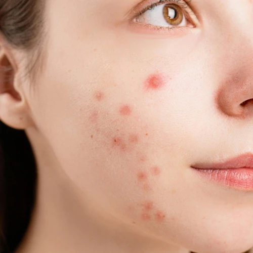 Arti Acne Shaming dan Alasan Mengapa Kamu Perlu Berhenti Melakukannya