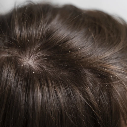 Hal-hal yang Bisa Dilakukan untuk Mengatasi dan Mencegah Ketombe