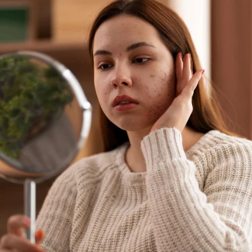Apakah Skincare Bisa Membantu Menghilangkan Bopeng di Wajah? Ini Penjelasannya!