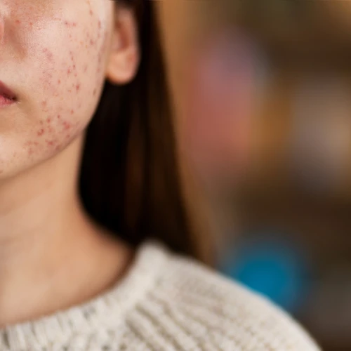 Kenapa Jerawat Susah Hilang Padahal Sudah Pakai Skincare