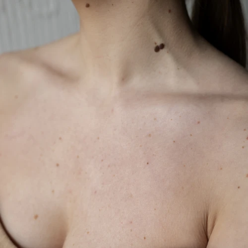 Penyebab Body Acne dan Cara Mengatasinya