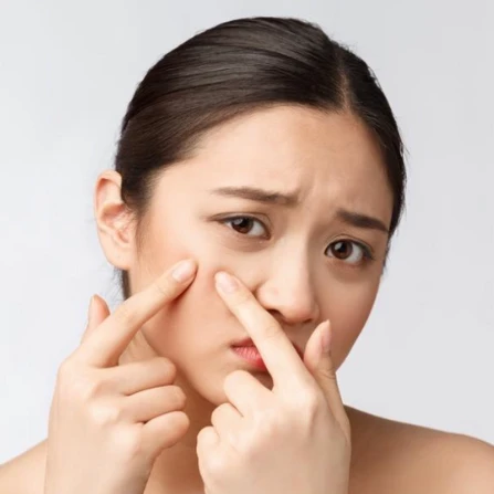 Cara Menghilangkan Komedo Hitam, Kenali Metode yang Tepat