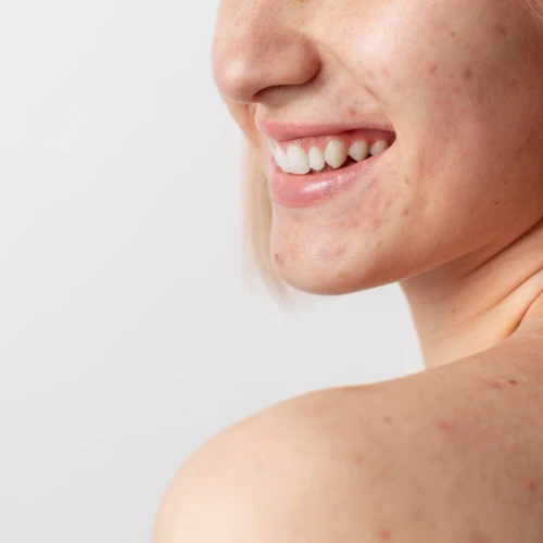 6 Cara Meredakan Jerawat Hormonal yang Kemerahan