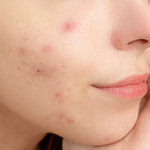 Jerawat Tidak Kunjung Sembuh? Mungkin Karena Hal-hal Ini…