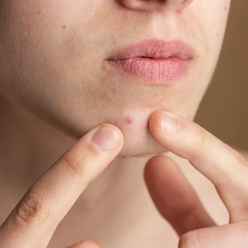 Cara Menggunakan Acne Patch Agar Tidak Meninggalkan Bekas Jerawat