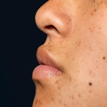 Ini 5 Cara Agar Flek Hitam Di Wajah Cepat Mengelupas