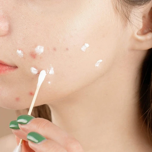 Dear Acne-Prone Skin, Ini Dia Cara Cepat Mengeringkan Jerawat