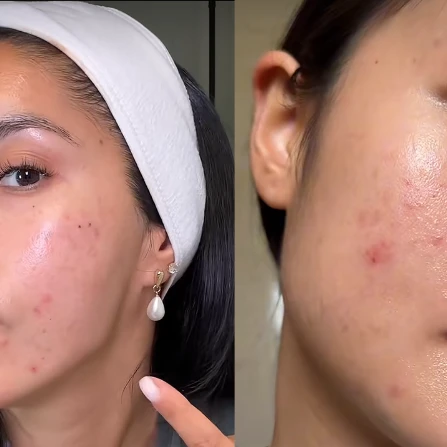 Breakout Artinya Apa? Ini Penyebab Munculnya Jerawat pada Wajah