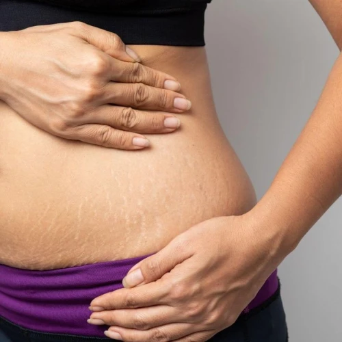 Stretch Mark: Apakah Bisa Hilang? Ini Faktanya