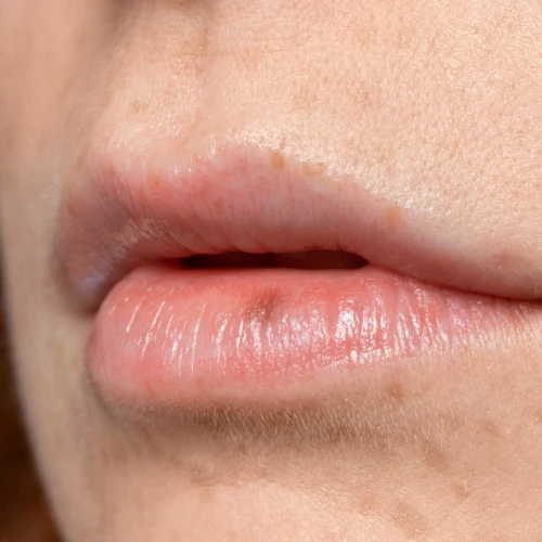 Penyebab Jerawat di Area Bibir & Mulut