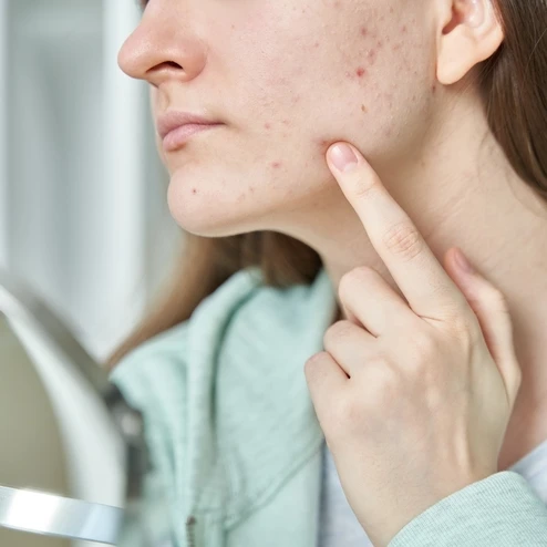 Membedakan Jerawat Hormonal dan Jerawat Akibat Produk Skincare yang Tidak Cocok