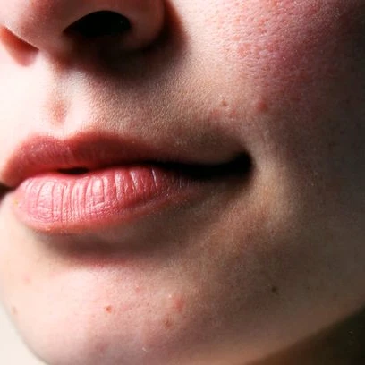 Cara Mengobati Luka di Sudut Bibir Secara Alami